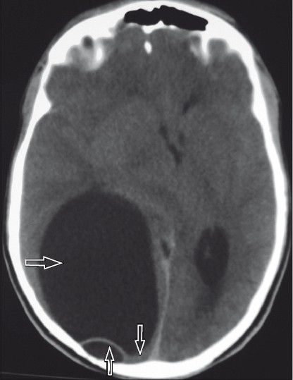 Multidetector-row computed tomography in cerebral hydatid cyst ...