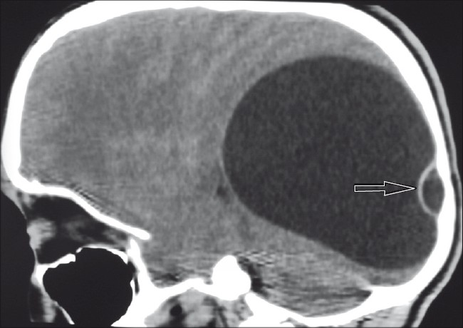 A thin nonenhancing septation (daughter cyst) posteriorly within the cyst (arrow)