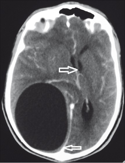 Cyst surrounded by brain tissue all around (leftward arrow) with midline shift toward left (rightward arrow)