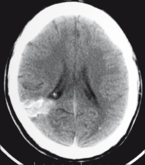 Plain axial CT scan showing a calcifi ed lesion in the right occipital region, extending from the cortical surface till the ependyma of the lateral ventricle. There is also evidence of a small calcified granuloma in the left occipital lobe