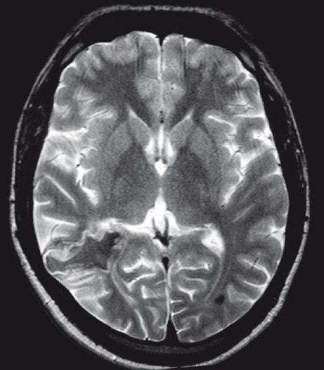 T2W axial MRI showing an irregular lesion in the right occipital region which is hypointense in the center with peripheral hyperintensity