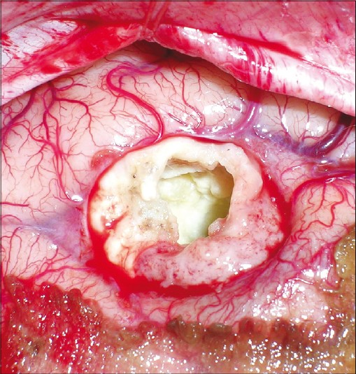 Intraoperative photograph showing the thickened irregular calcified wall after evacuation of contents. The plane of differentiation between the cyst wall and brain parenchyma is also visualized well