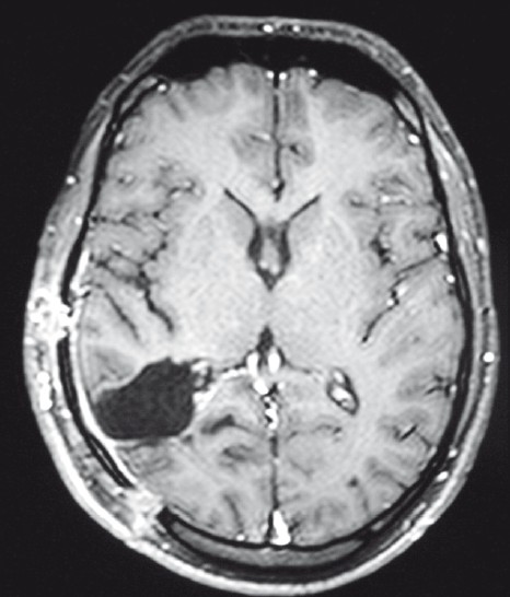 Postoperative contrast MRI showing total excision of lesion with postoperative changes