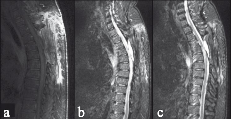 Magnetic resonance imaging sagittal T2W images showing a hyperintense mass, placed dorsal to the cord extending from D3 to D5 level, with cord compression