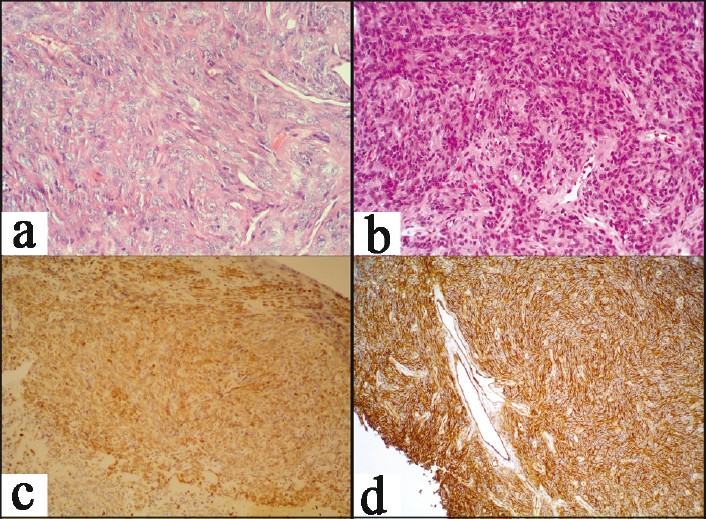 Photomicrographs showing (a) spindle cell proliferation in interfascicular pattern with thin slit-like blood vessel, H and E ×20; (b) photomicrograph showing the hyperchromatic spindle cells with mild pleomorphism and infrequent mitoses, H and E ×40; (c) immunohistochemistry for bcl2-negative staining pattern; and (d) immunohistochemistry showing vimentin positivity among the tumor cells