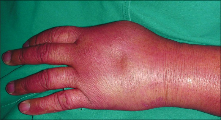 Left hand was edematous and had purplish-blue discoloration without blisters