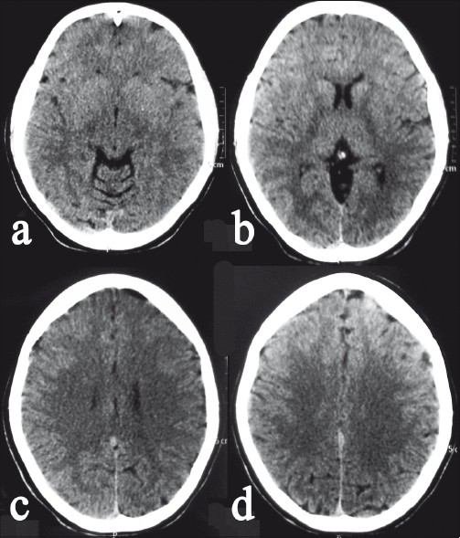 CT scan brain, plain showing a thin posterior interhemispheric acute subdural hematoma.