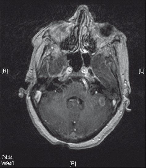 Ring enhancing lesion seen in left cerebellum on T1 weighted contrast enhanced gradient echo images.