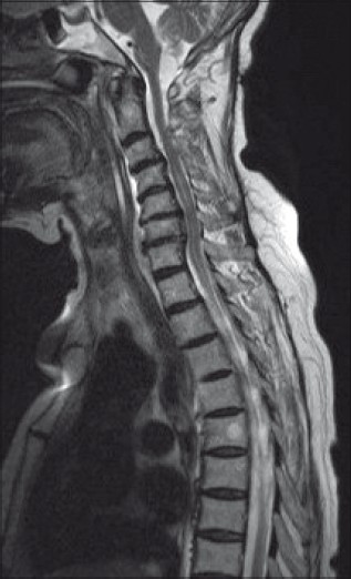 T2 W saggital image of the spine showing syrinx extending from C5 up to D6 with extensive degenerative changes in the cervical vertebrae (On the 10th day of admission)