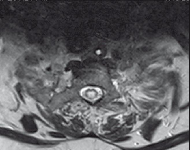 Axial T2W image showing evidence of central hyperdensity in the spinal cord – Syrinx (On the 10th day of admission)