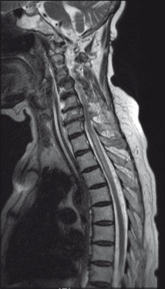 T2 W saggital image of the spine showing syrinx extending up to D6 with extensive degenerative changes in the cervical vertebrae (On the 10th of admission)