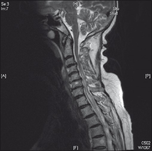 T2 W saggital image of the spine showing syrinx extending up to D6 with extensive degenerative changes in the cervical vertebrae (On the 10th of admission)