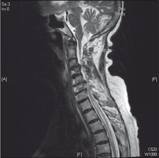 T2 W saggital image of the spine showing syrinx extending from C5 up to D6 with extensive degenerative changes in the cervical vertebrae (On the 10th day of admission)