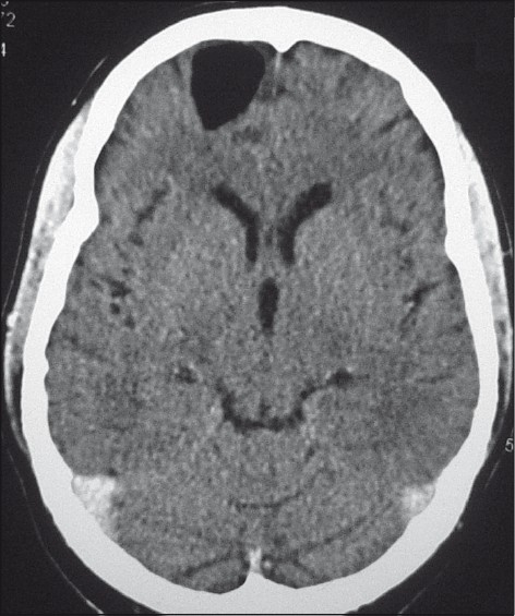 CT brain (axial view) showing a hypodense lesion in the right frontal lobe