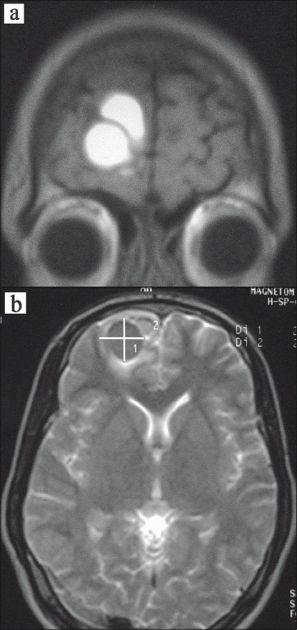 (a) MRI brain T1-weighted image (coronal view) showing hyperintense lesion in the right frontal lobe. (b) MRI brain T2-weighted image (axial view) showing hypointense lesion in the right frontal lobe