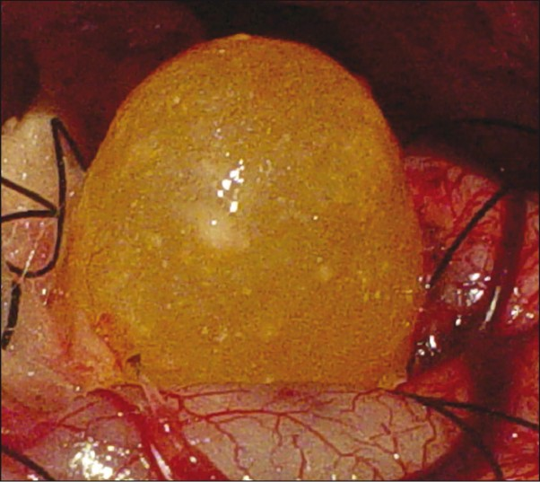 Intraoperative photograph showing yellowish cystic lesion