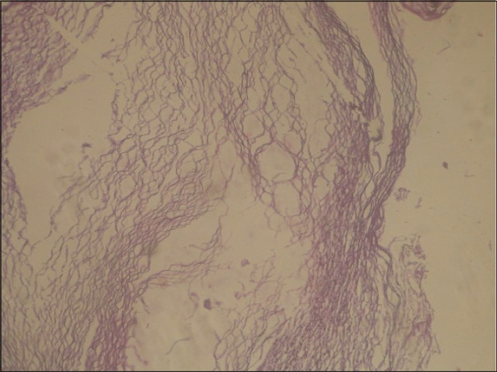 Histopathologic section of the resected specimen showing lamellar keratin flakes. (H and E stain)