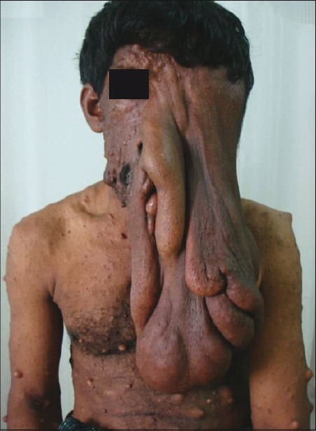 Picture showing patient with large PNF