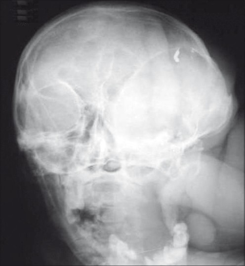 Plain X-ray of the skull showed sphenoid dysplasia