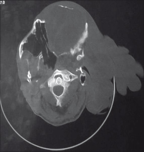 CT scan of the CVJ revealed AAD