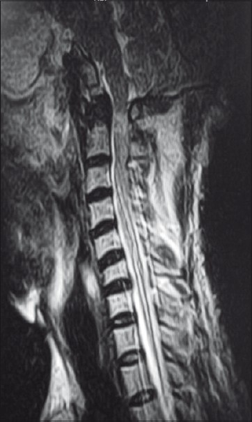 Magnetic resonance imaging of the cervical spine showed AAD, cord compression at CVJ and syrinx from C2 to C7