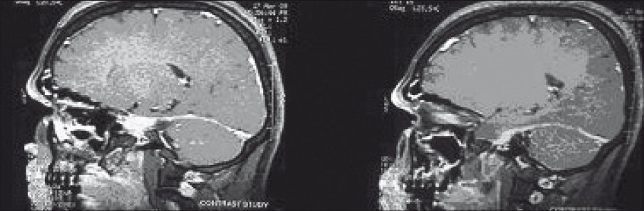 Enhancement of tentorium is seen in post-contrast T1- weighted imaging