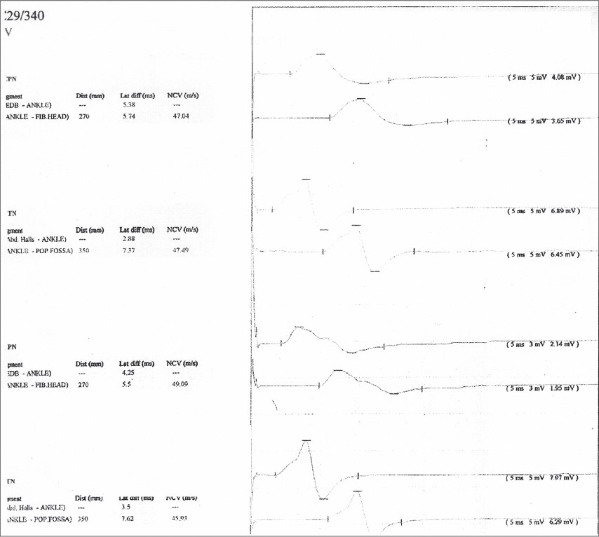 NCV study showed diminished C-map of lower limb peroneal nerves, suggestive of asymmetric axononeuropathy