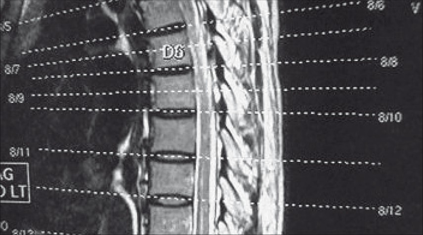 MRI dorsal spine T2 sagittal images show hyperintense signals involving dorsal cord