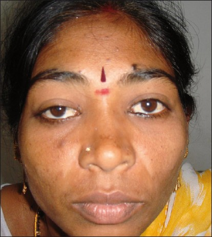 Clinical picture of the patient taken at rest showing right eye partial ptosis