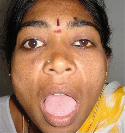 Clinical picture of the patient taken on opening the mouth showing widening of the right eye palpebral fi ssure