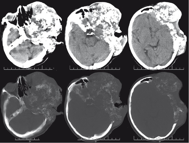 Plain axial CT images of the head soft tissue and bone showing an aggressive, densely ossifi ed bone-forming tumor with extensive involvement of the soft tissue and bony destruction of the anterior, middle, and part of the posterior cranial fossa on left side producing cloud-like pattern of mineralization