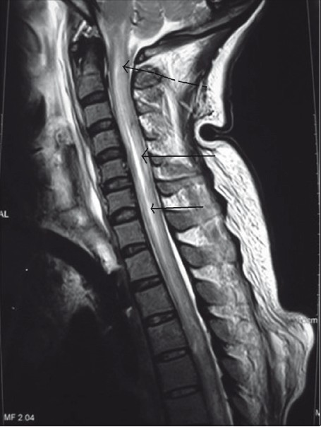 MRI showing ischemic changes from brainstem to T4 thoracic segment