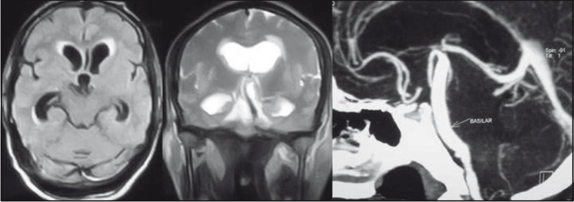 Left and middle pictures show dilated ventricles with dolichoectatic basilar artery compressing the midbrain and outflow of the third ventricle. The right picture shows the computerized tomography angiogram with the dilated and elongated basilar trunk extending into the suprasellar space