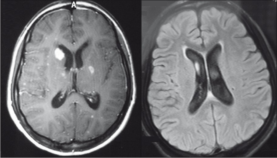 a: Multiple tuberculomas and basal meningitis b: Hydocephalus in cranial imaging