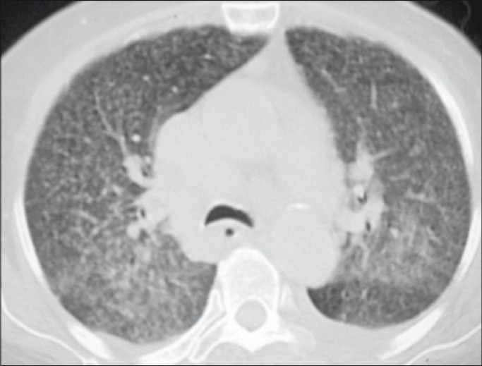 Miliary pattern in high resolution computed tomography