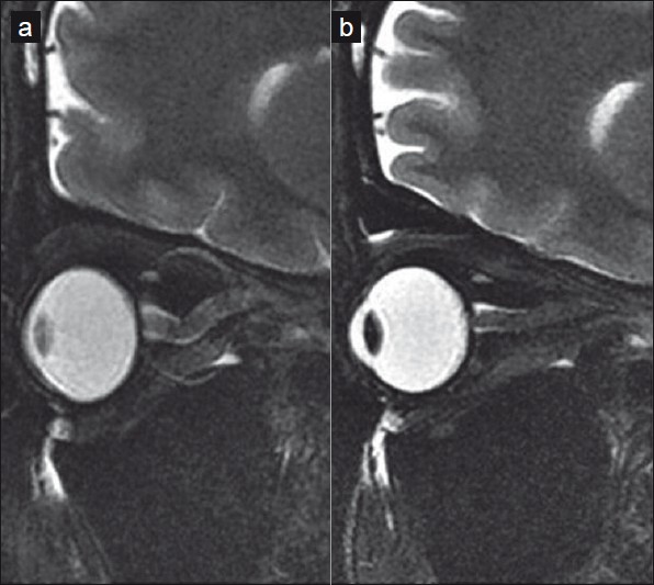 T2 fat saturated oblique saggital image through the optic nerve (a, b) shows the optic nerve buckling with prominent perioptic subarachnoid space (a). Post-LP, the optic nerve straightens with some reduction in the perioptic fluid (b)