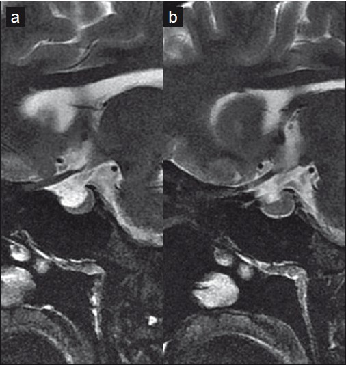 Saggital images of the sella show "partial empty sella" (a), which, following CSF drainage, is normalized (b)