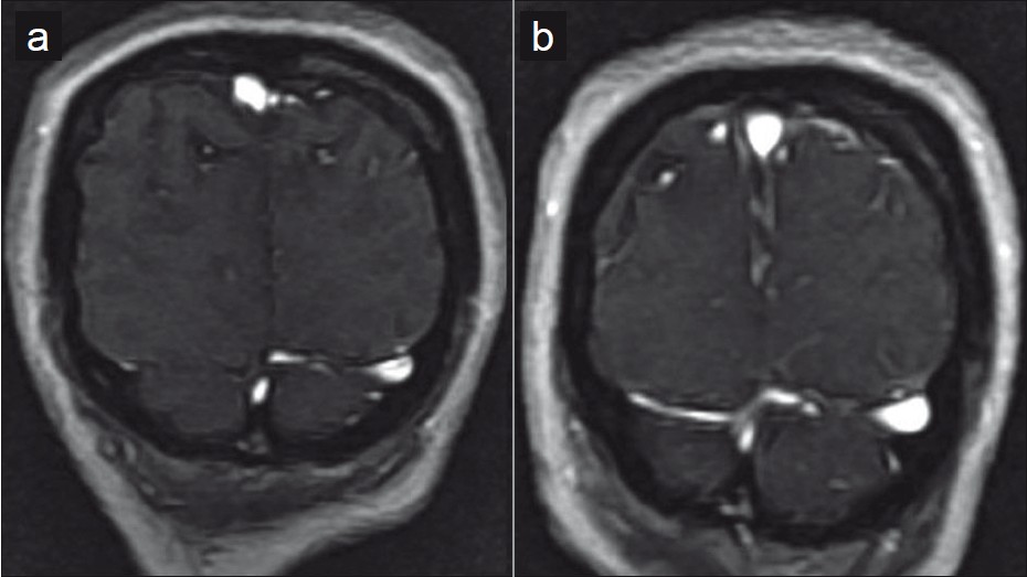 Paucity of the cortical veins and non visualized right transverse sinus (a) is reversed following CSF drainage with distension of the sinuses and better visualization of the cortical veins (b) in this TOF venogram.