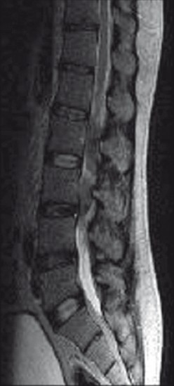 MRI LS spine T2W sagittal cut showing heterointense lesion in the conus cauda