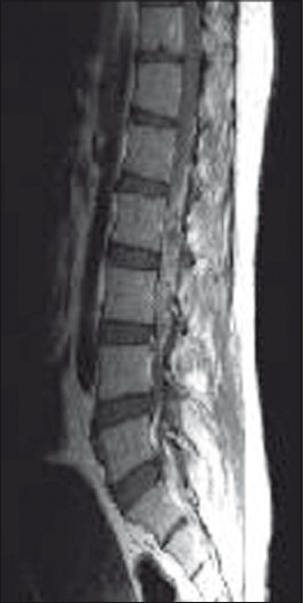 MRI LS spine T1W sagittal (contrast) showing L1–L4 homogenous enhancing lesion