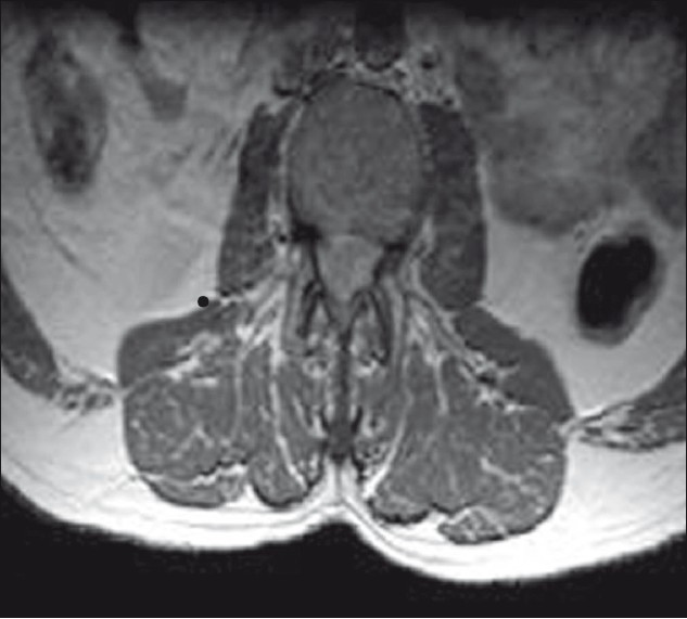 MRI LS spine T1W axial (contrast) showing widening of cord with homogenously enhancing lesion, no subarachnoid space seen around the cord.