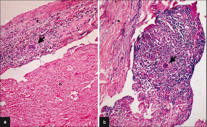 (a) Large zones of caseous necrosis (n) seen with overlying dura infi ltrated by epitheloid cells and Langhan's giant cells (arrow) [a: HEx240, b:HEx120], (b) Microphotograph shows tuberculous granulation tissue with Langhan's giant cells (arrow) adherent to overlying infl amed dura (asterix)