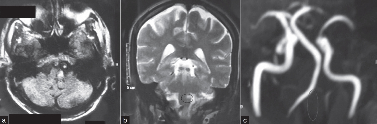 (a) A FLAIR image showing a high signal in the left postero lateral medulla suggestive of an infarct (circle in image) and there is a white round lesion immediately in front of the medulla indicative of the thrombosed left vertebral artery (circle in image), (b) Image shows a coronal T2 weighted MRI in which there is high signal (hyperintensity) in the left medulla which is suggestive of an infarct (circle in image). (c)-MRI angiography sequence (3D Time of Flight (TOF) sequence). This shows absence of the normal left vertebral artery (shown with circle in image)