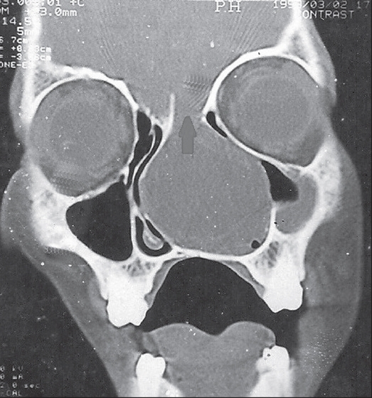 Cranial CT scan showed a large defect in the right transethmoidal region with a large mass filled with fluid