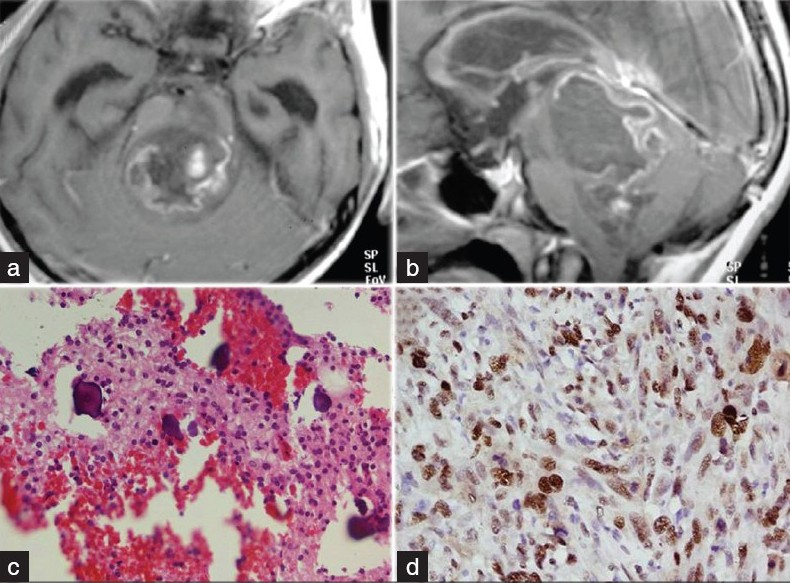 (a) T1-weighted contrast-enhanced image showing variegated contrast uptake by the tumor. (b) Sagittal section showing pontine tumor completely occluding the fourth ventricle. (c) Photomicrograph showing psammoma body like micro-calcification in tumor (Hematoxylin and Eosin, ×200). (d) Photomicrograph showing nuclear Ki67 labeling in the tumor cells (Ki67 immunostain, ×400).