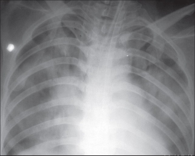 Bedside X-ray chest showing bilateral fluffy opacities suggestive of pulmonary edema