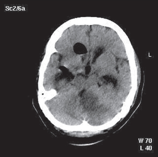 Post EVD non contrast CT brain showing left-sided cerebellar infarct with a mass effect pushing the brainstem to the right, chinking of fourth ventricle and hydrocephalus. Also seen is air within the ventricle following the EVD