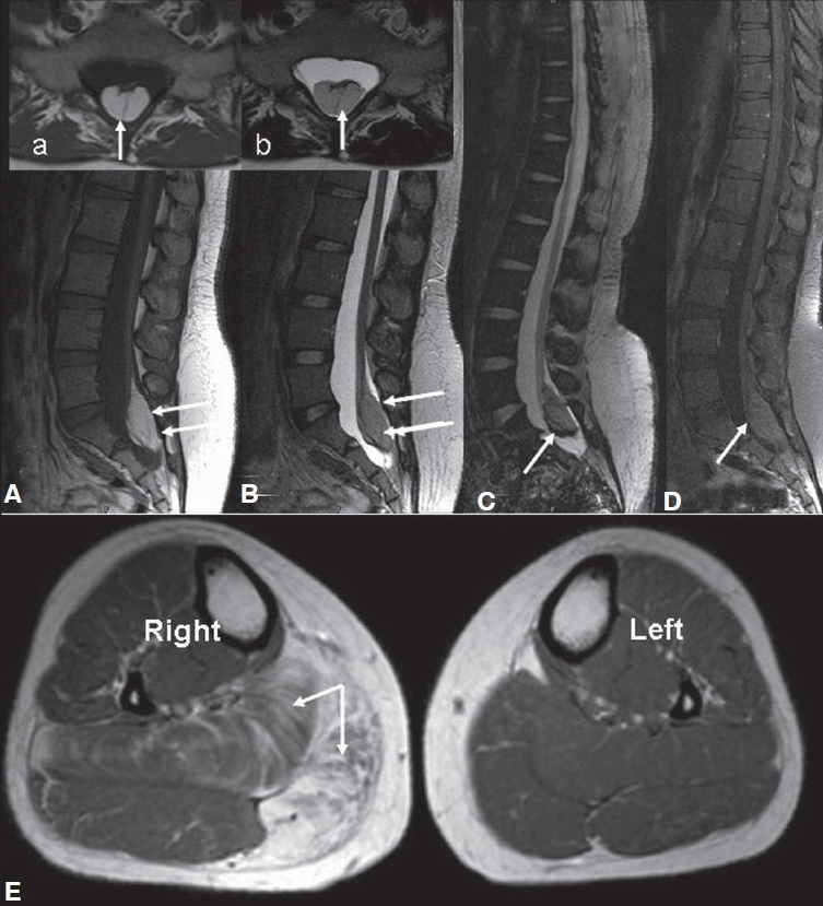 MRI of lumbosacral spine (1A-D) revealed a very well circumscribed intradural extramedullary T1 hyperintense (A, a), T2 isointense (1B,b) lesion at the level of S1 and S2 with scalloping of the posterior border of these two vertebrae; along with chemical shift artefact on gradient imaging (1C); There was no enhancement on post-contrast fat saturated T1W images (1D). MRI of both the calves (1E) revealed enlargement of right calf with involvement of soleus and medial head of gastrocnemius with fatty replacement of muscle tissue.