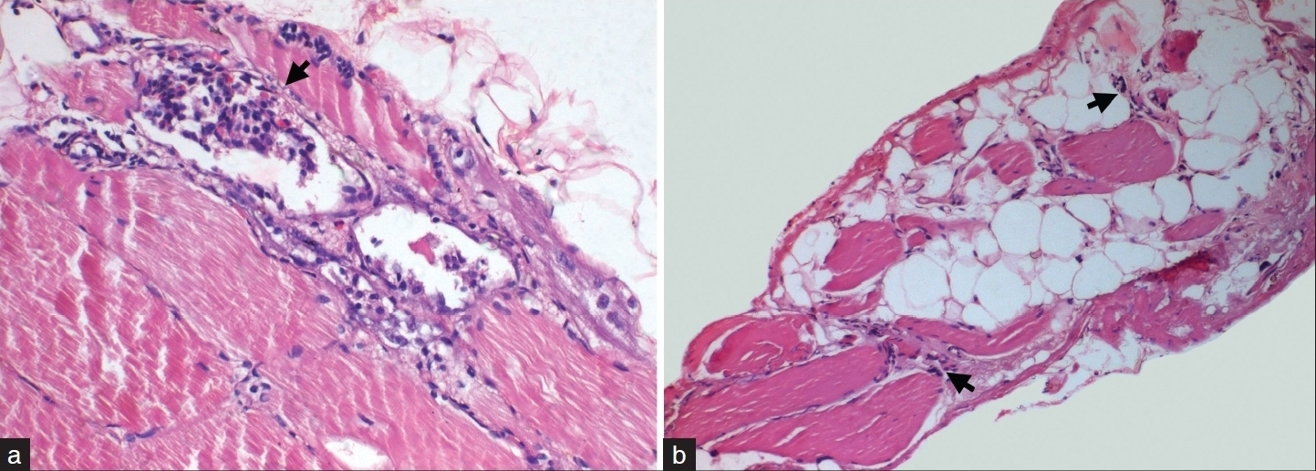 Muscle biopsy from right gastrocnemius revealed myopathic features with prominent myophagocytosis (arrow, A) and regeneration. Note presence of eosinophils in the infiltrate. In addition, neurogenic features with atrophic fibres with clumped myonuclei (arrow, B) and adipose tissue infiltration is also noted. (a: H and E, ×120, b: H and E, ×40)