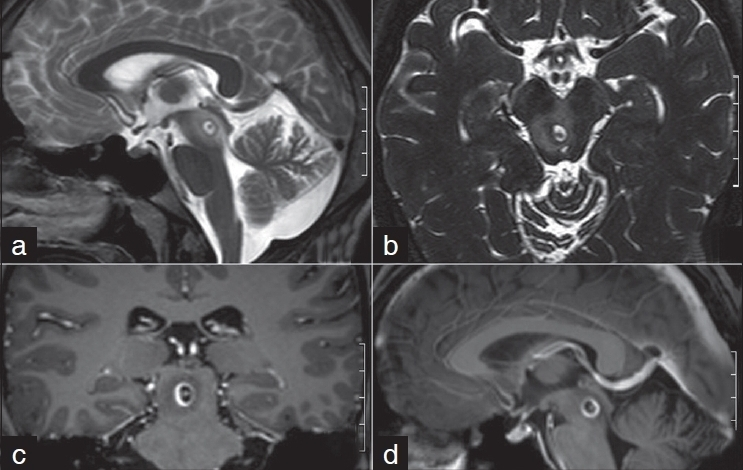 MRI brain: T2 sagittal (a), CISS 3D (b), postcontrast coronal (c) and sagittal (d) showing a single ring lesion with an enhancing scolex in midbrain with perilesional edema.